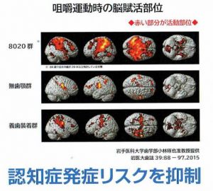 認知症